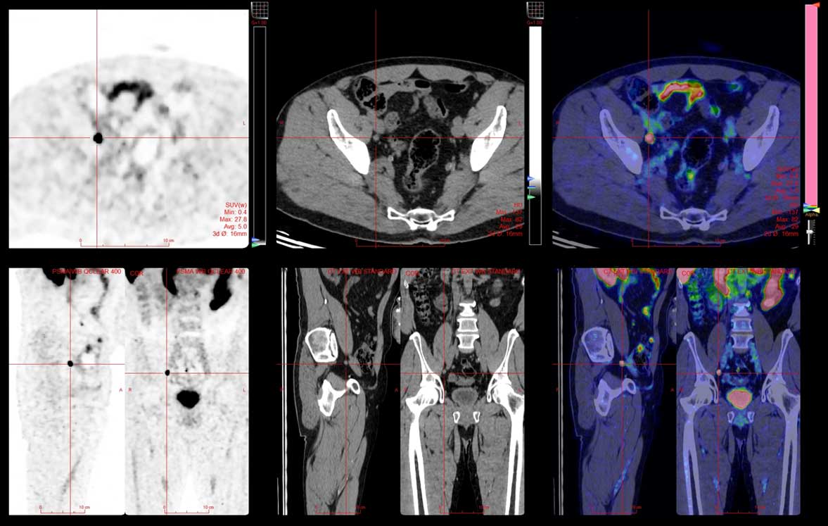 PSMA PET CT Imaging - Coming Soon | MIC Medical Imaging